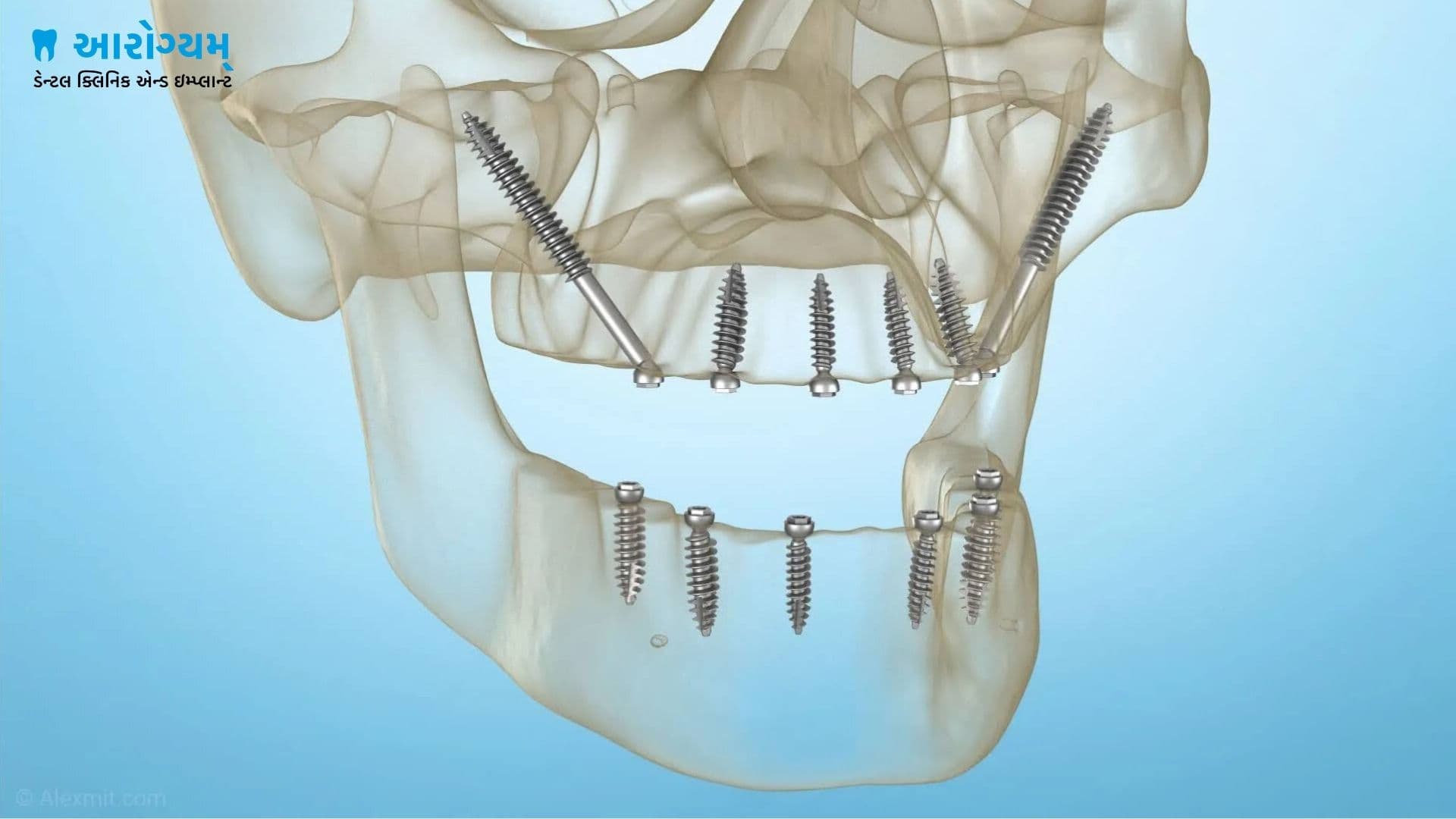 Full mouth pterygoid implant support near Rajkot