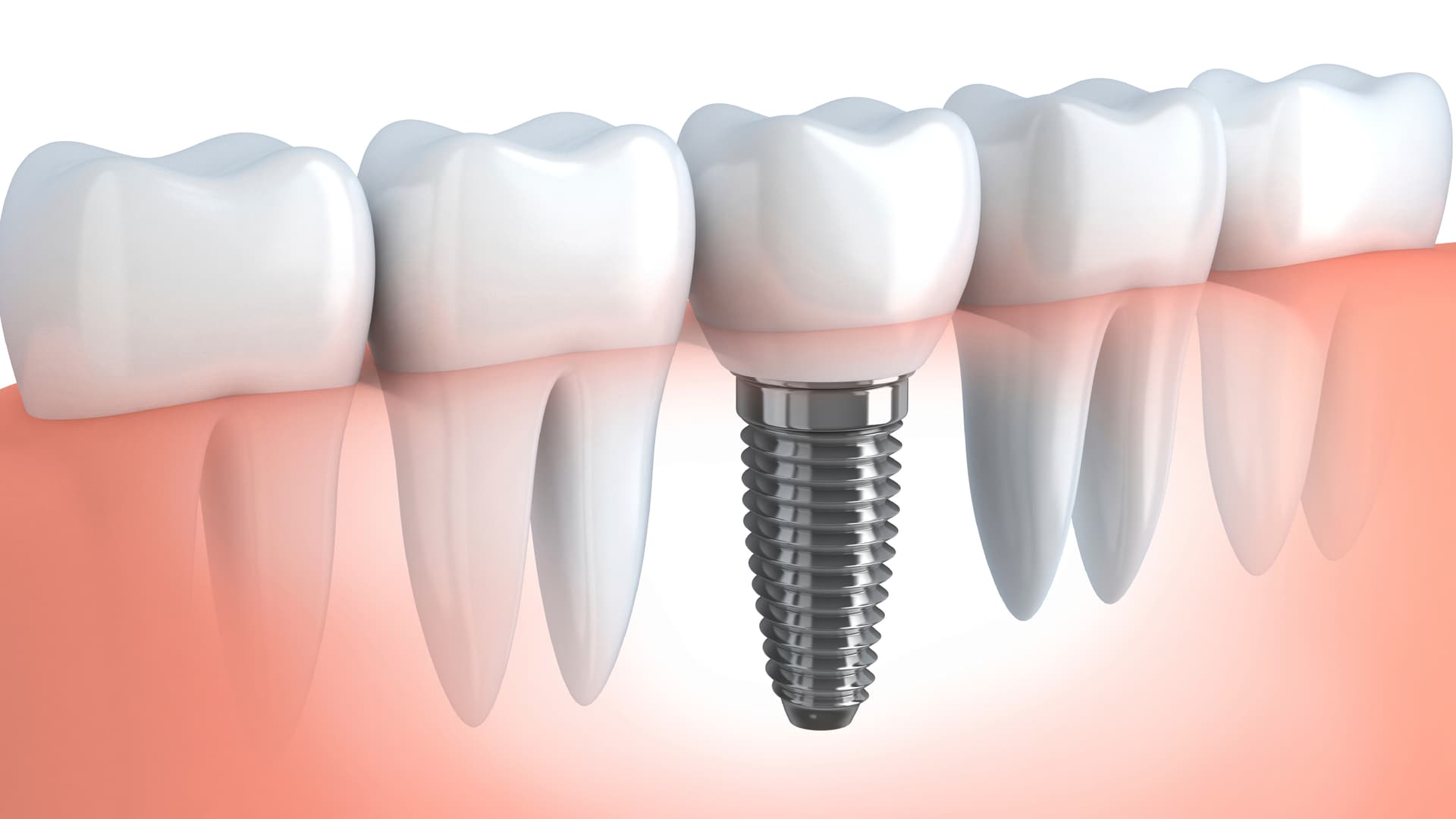 Zirconia fixed teeth treatment at Aarogyam Dental Clinic Rajkot