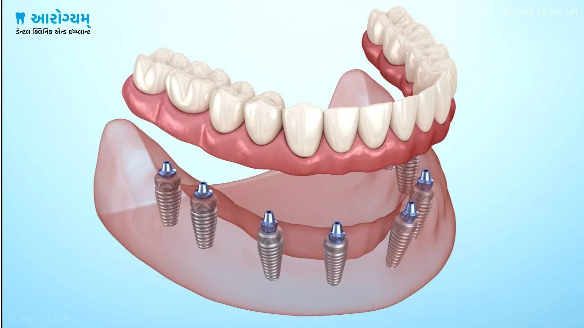 Pterygoid Implants in Rajkot