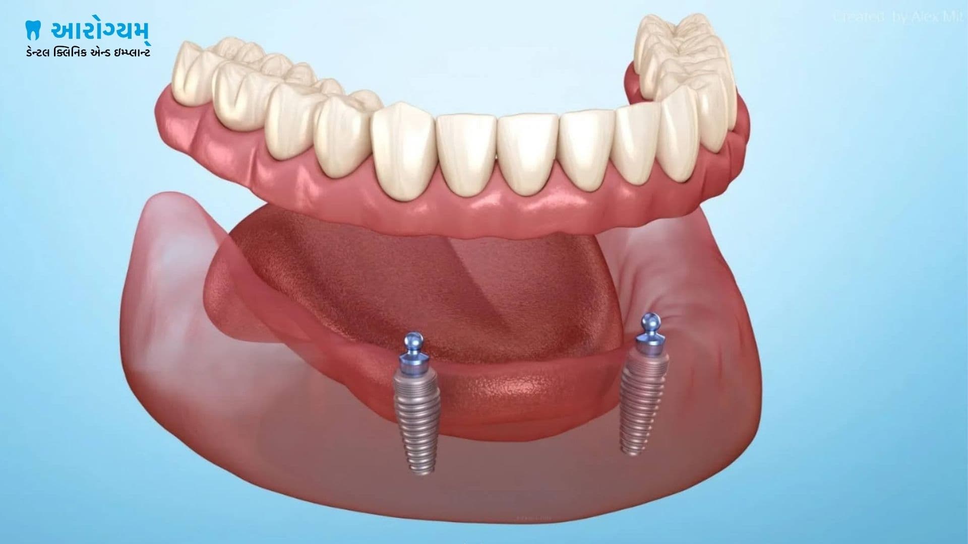 Snap on denture implants at Gandhidham