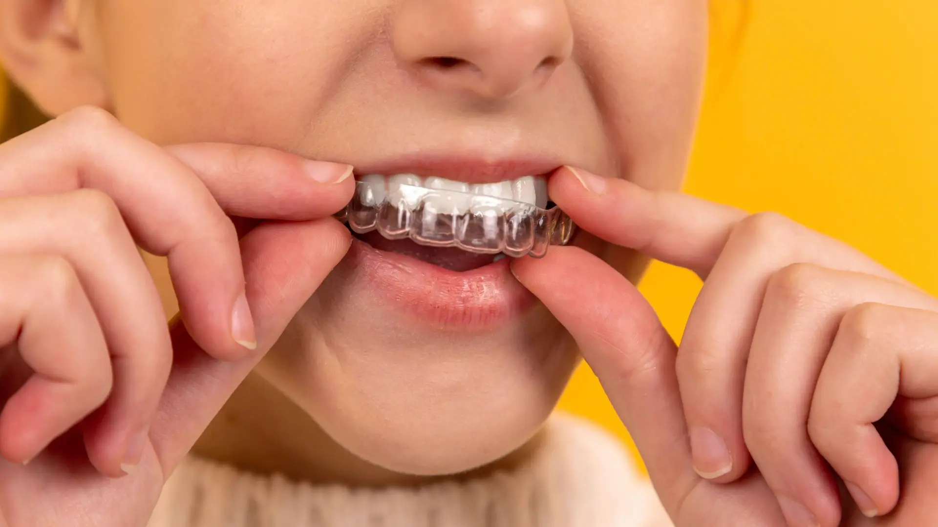 Aligners and braces teeth straightening at Aarogyam Dental Rajkot