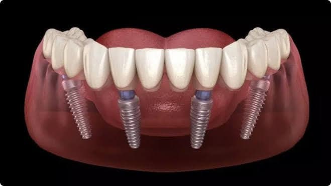 Dental implants treatment at Aarogyam Dental Clinic and Implant Centre Rajkot