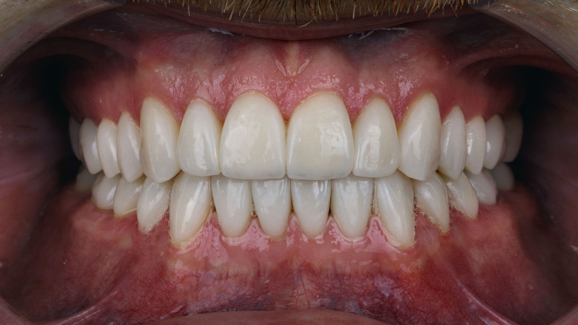 Alambadi, Porbandar's Leading Specialist for Full Mouth Rehabilitation.