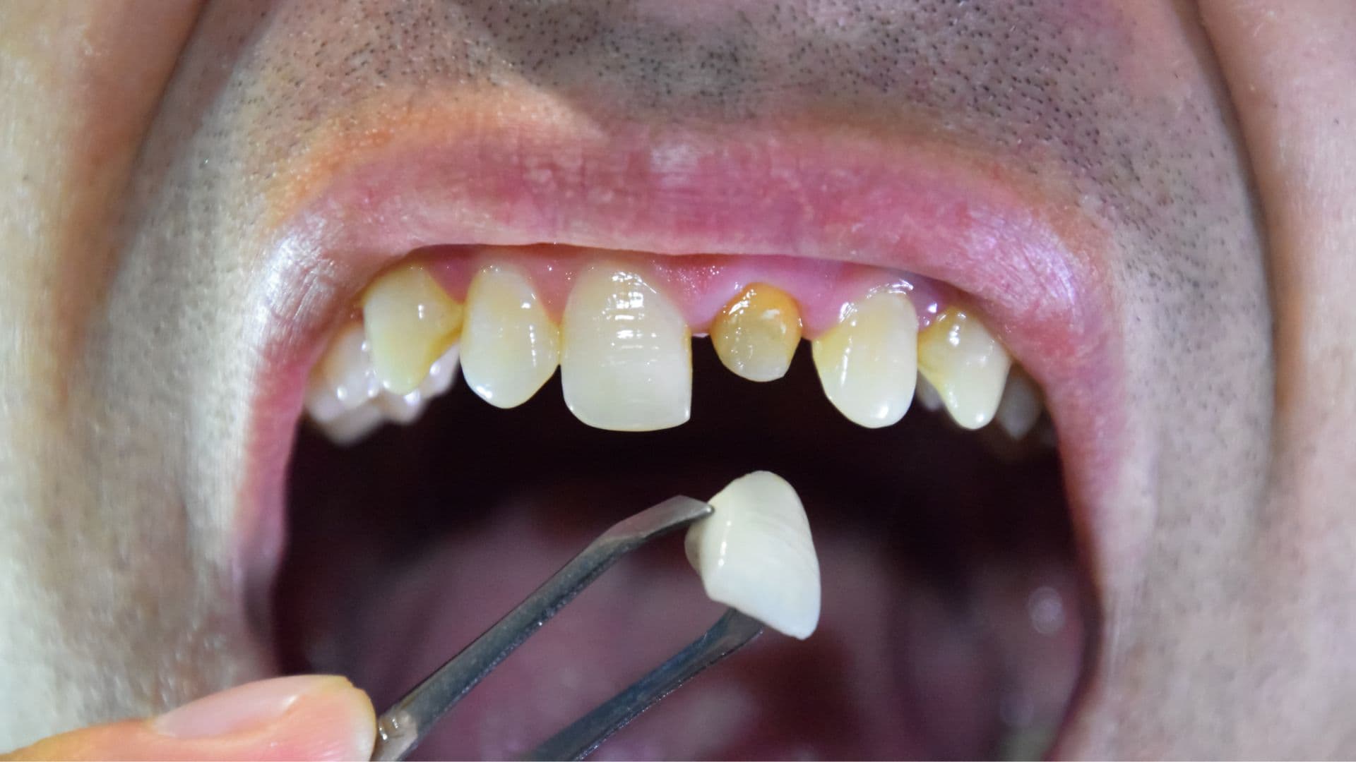 Full Mouth Rehabilitation Cost near Alambadi, Porbandar