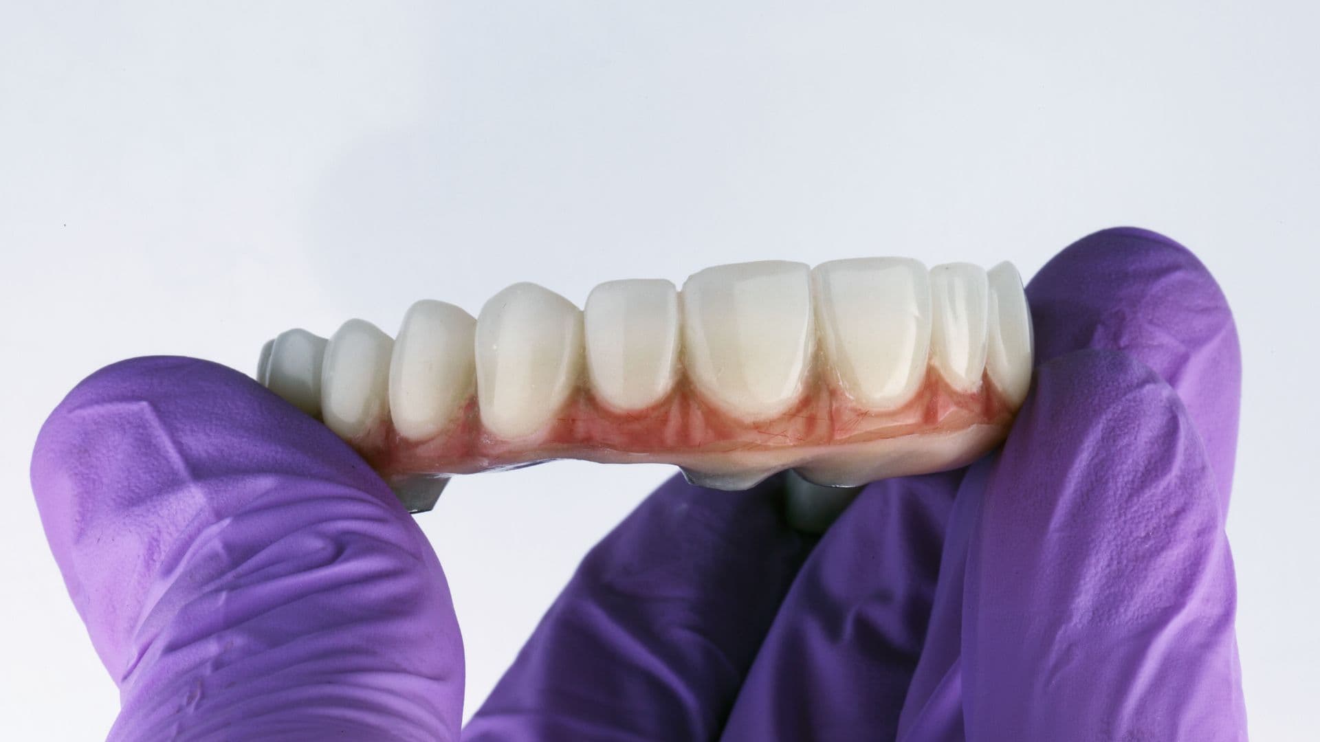 Affordable Full Mouth Rehabilitation near Alambadi, Porbandar for a Beautiful Smile
