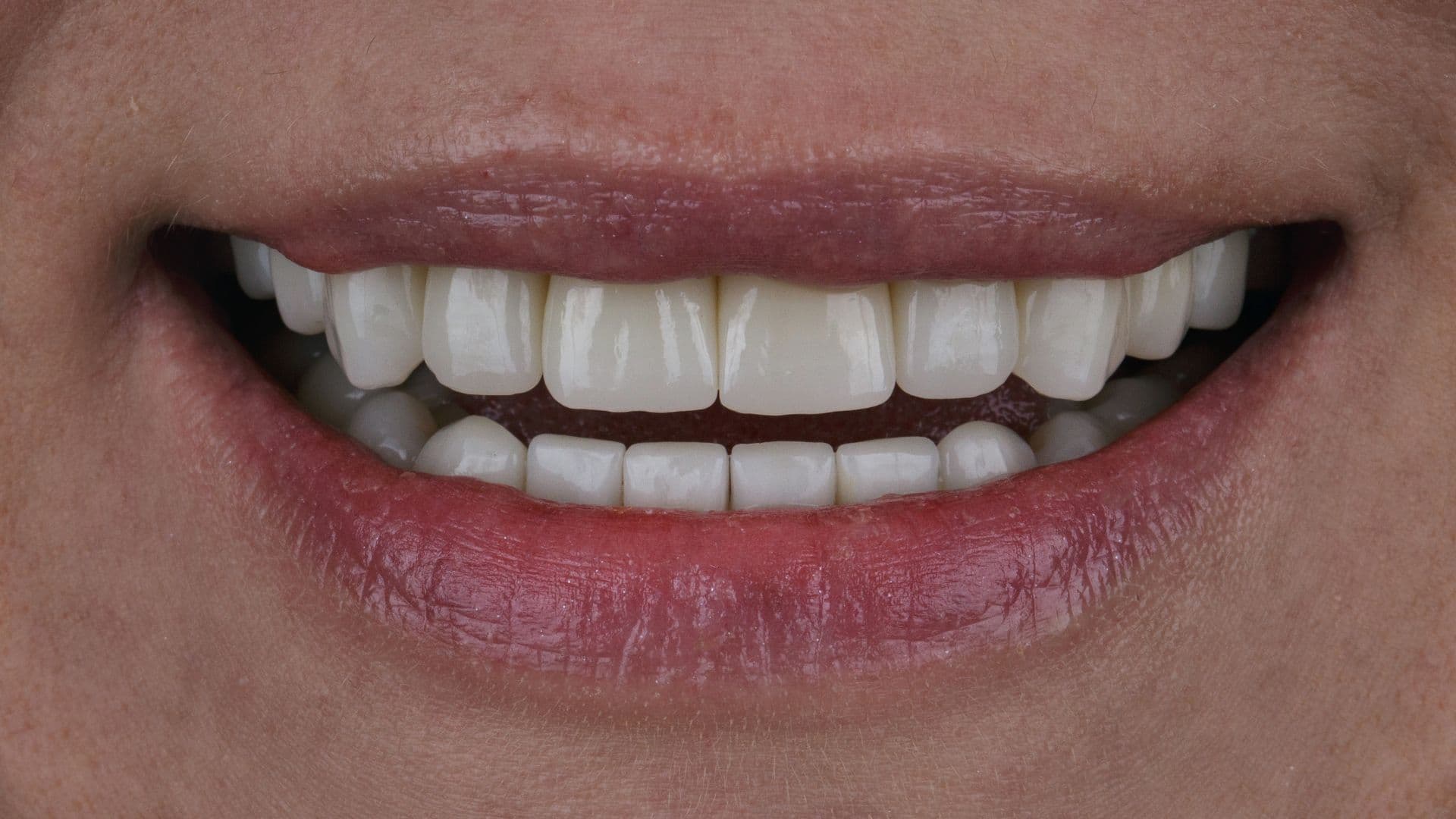 Get the Best Full Mouth Rehabilitation for a Perfect Smile | Best Rated