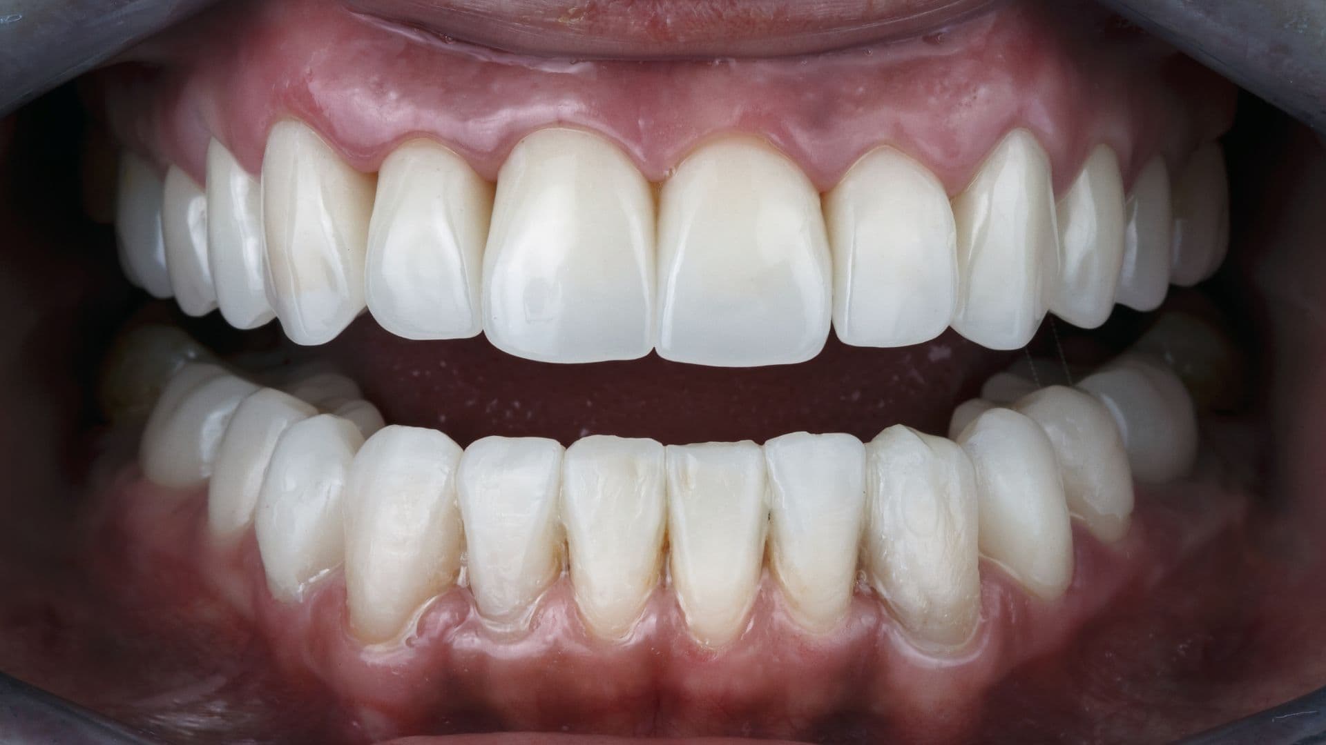 Alambadi, Porbandar's Leading Prosthodontist for Full Mouth Rehabilitation.