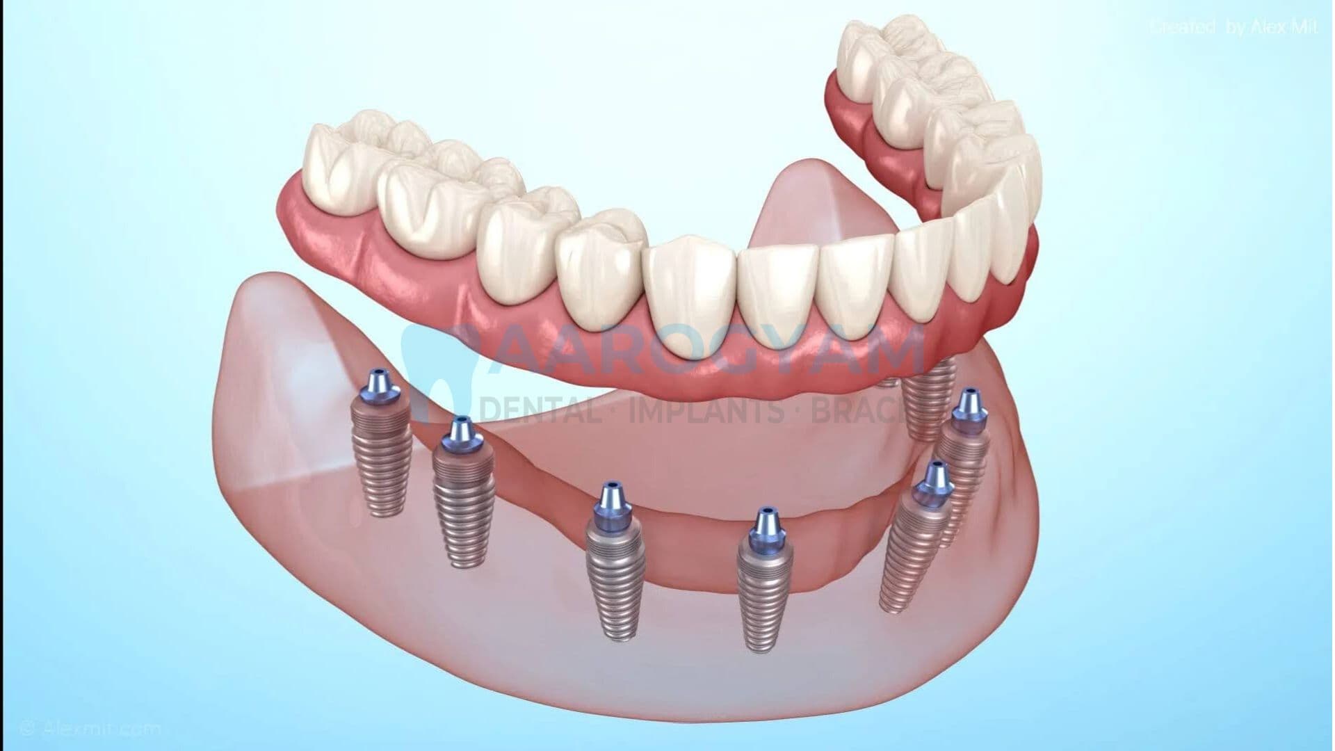 Dental implant treatment case at Aarogyam Dental Rajkot