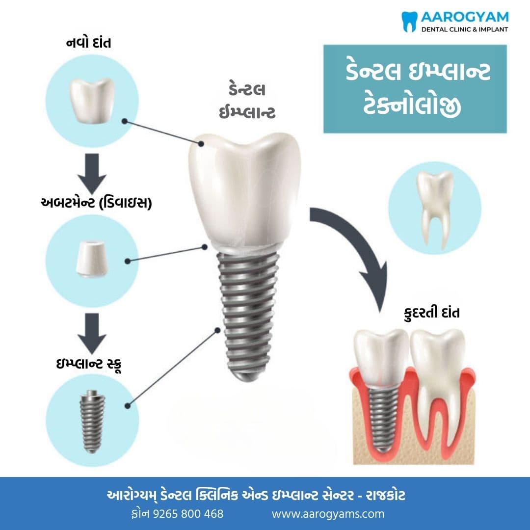 Dental implant procedure result at Aarogyam Dental Rajkot
