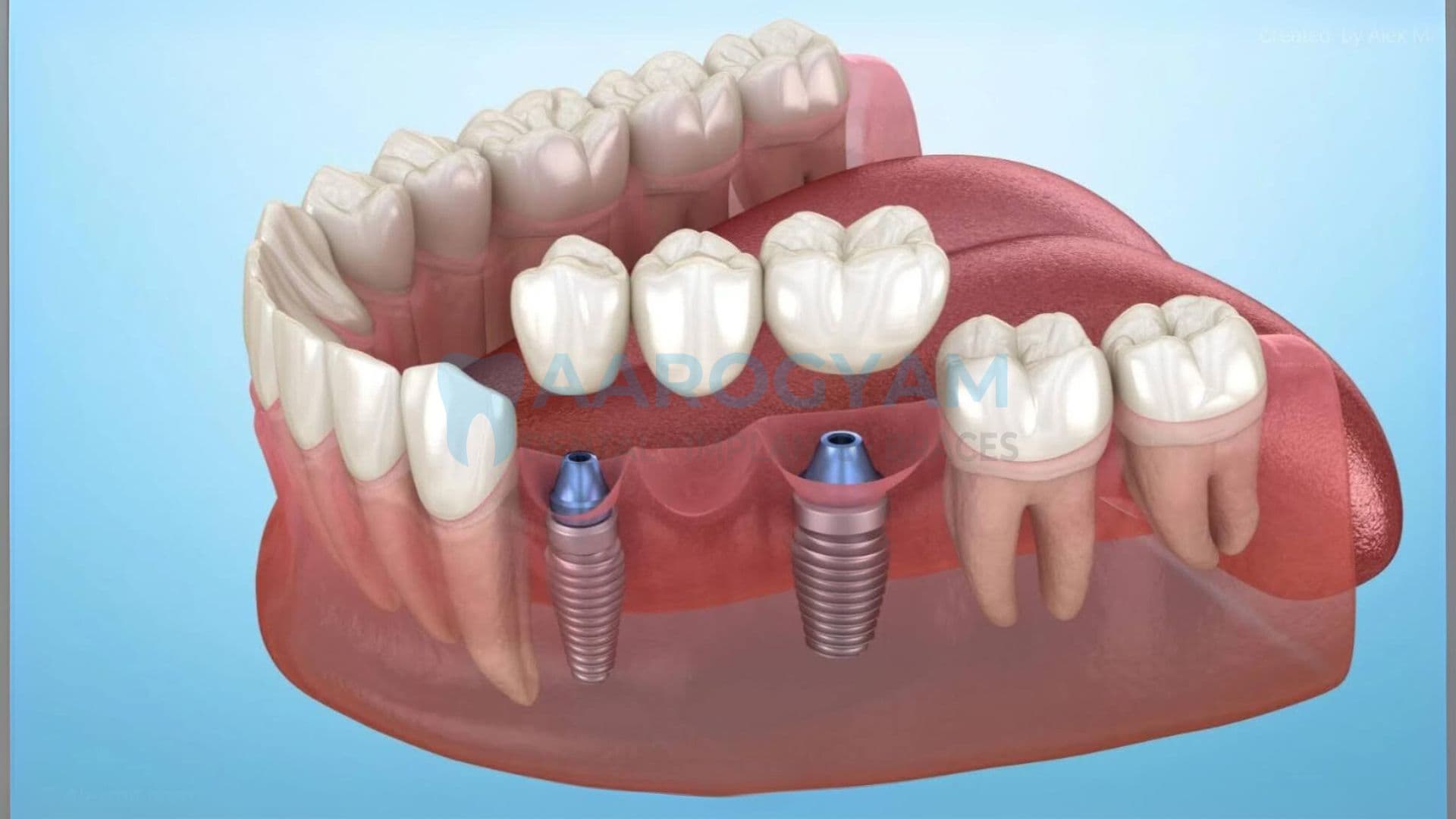 Full mouth dental implants clinical photo at Aarogyam Dental