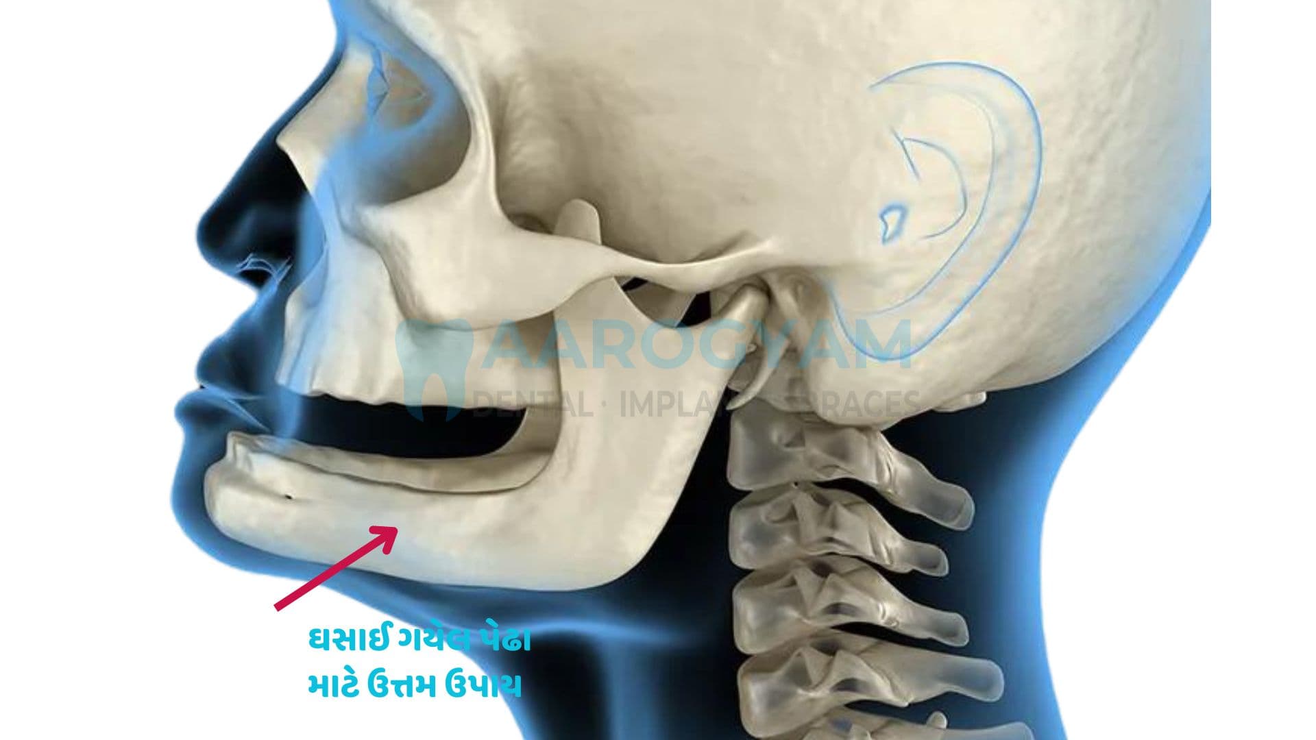 Fixed teeth with dental implants at Aarogyam Dental Rajkot