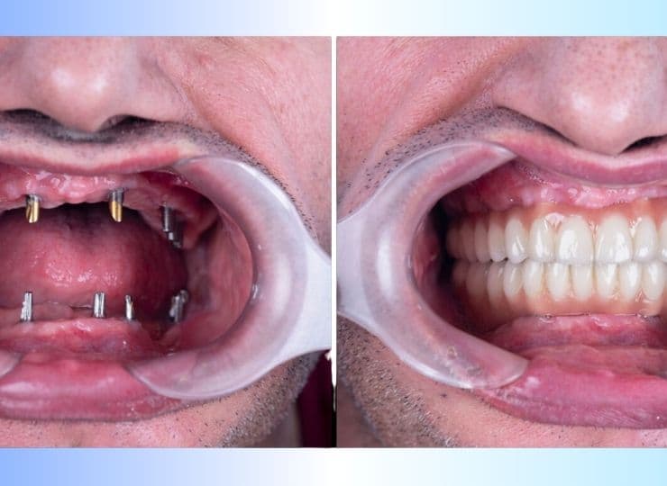Immediate teeth dental implants in Rajkot