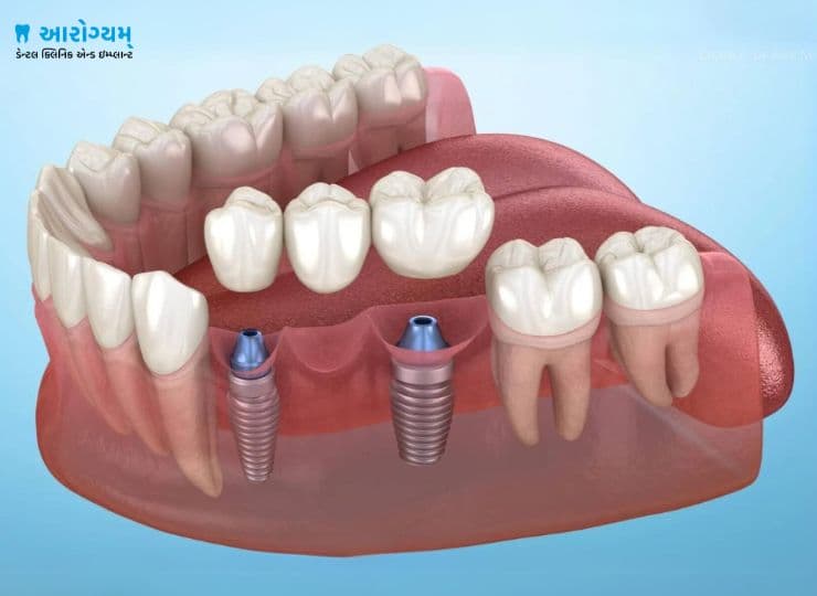 Multiple teeth dental implants bridge in Rajkot