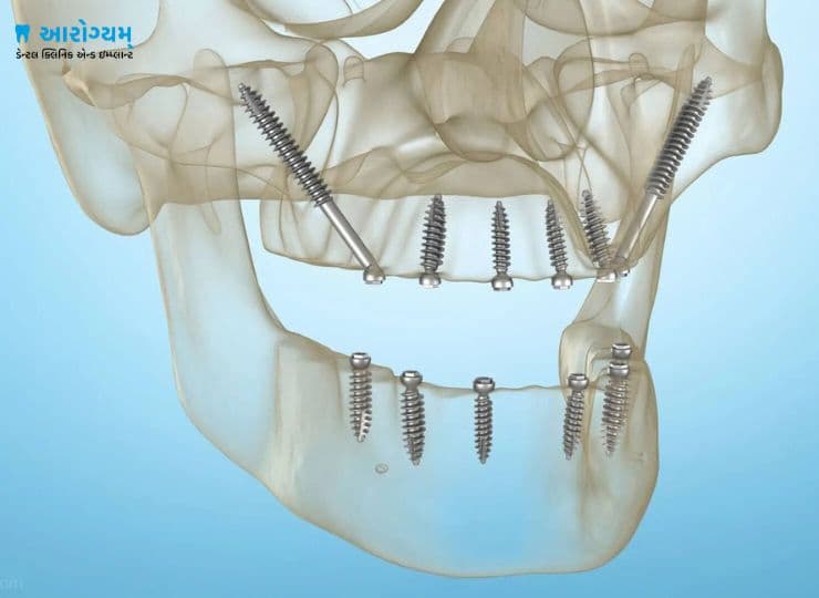 Dental implants consultation at Aarogyam Dental Rajkot