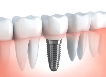 Dental implants treatment in Rajkot