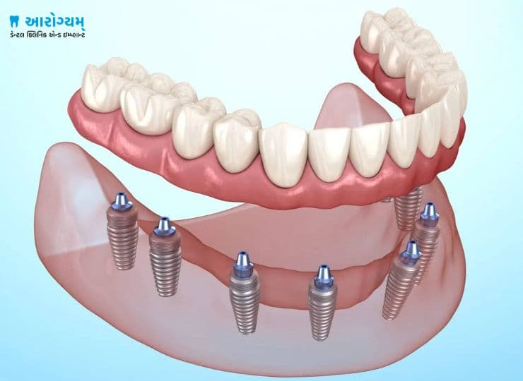 Full mouth fixed teeth implants treatment in Rajkot