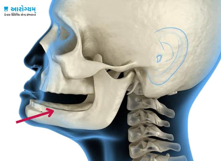 Dental implants for poor bone condition in Rajkot