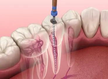 Root canal treatment in Rajkot