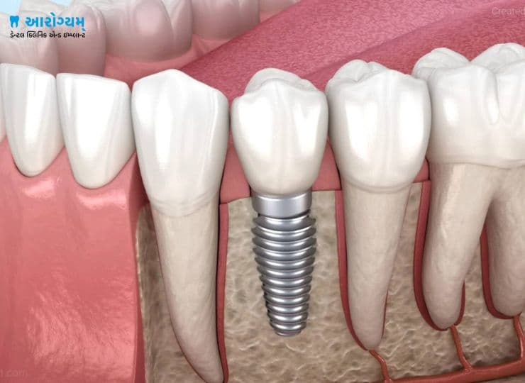 Single tooth dental implant in Rajkot