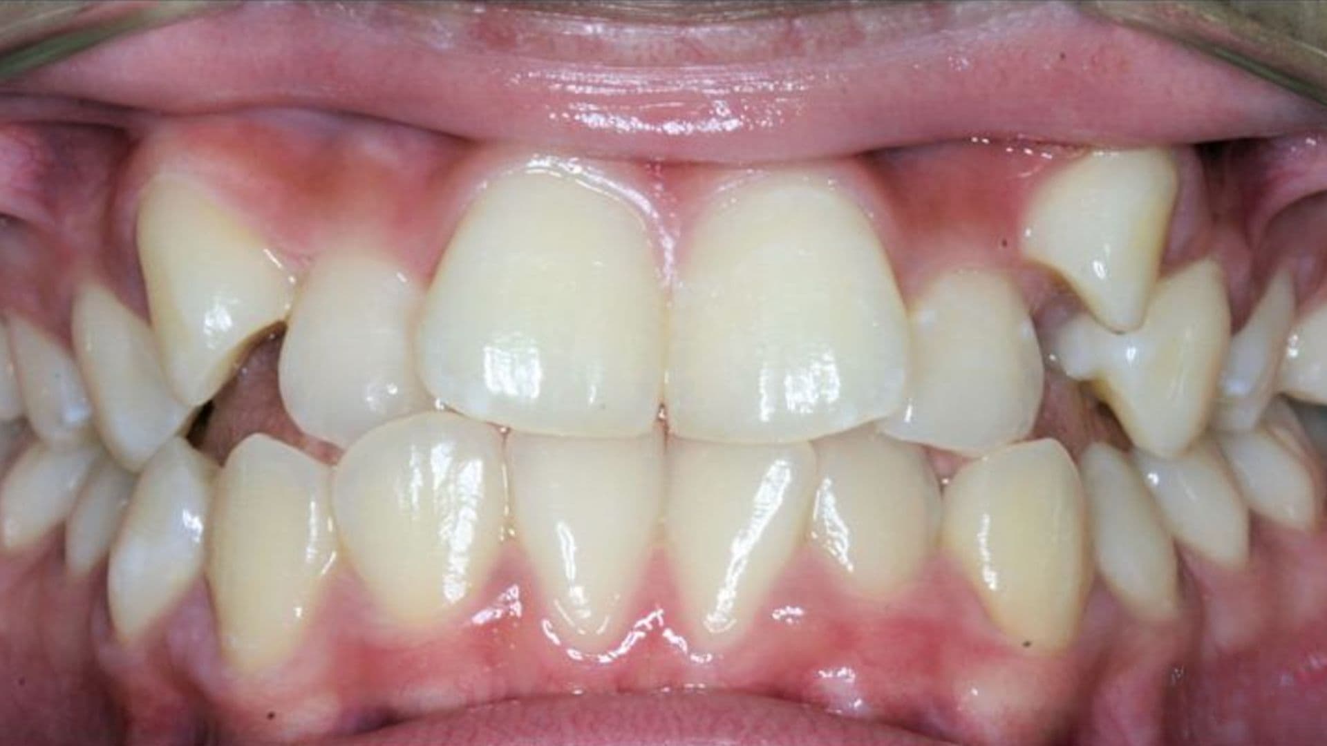 Before orthodontic treatment