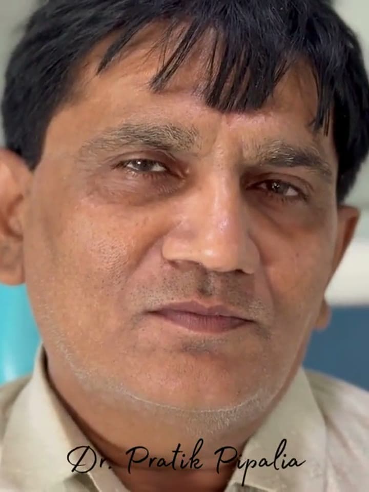 C Rameshbhai from Junagadh after dental implant at Aarogyam Dental Clinic, Mavdi, Rajkot, Gujarat