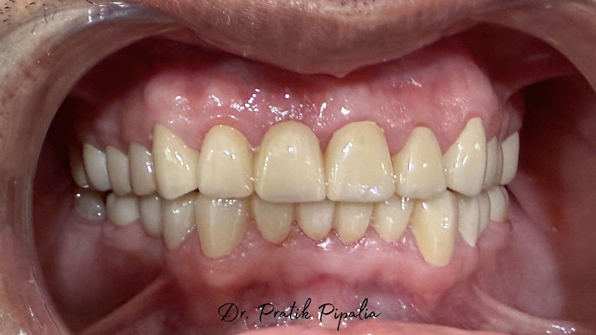 Jayeshbhai S after full mouth rehabilitation at Aarogyam Dental Clinic, Mavdi, Rajkot, Gujarat — US dental tourism patient