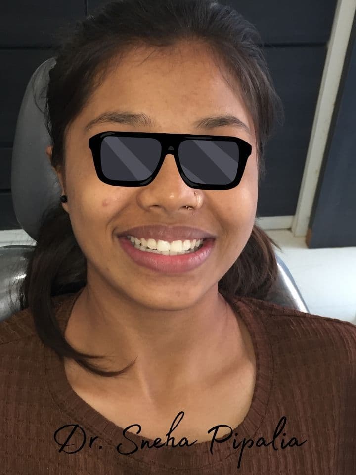Nirali H after braces treatment at Aarogyam Dental Clinic, Mavdi, Rajkot, Gujarat