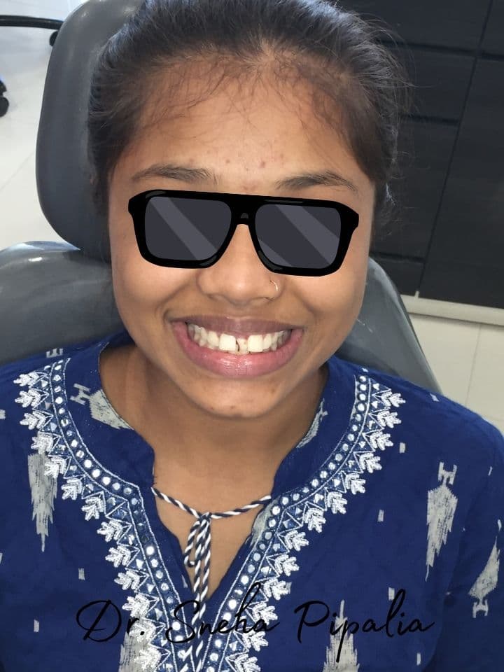 Nirali H before braces treatment at Aarogyam Dental Clinic Rajkot