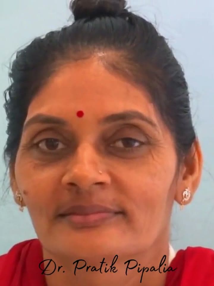 S Ramaben from Gondal after dental implant at Aarogyam Dental Clinic, Mavdi, Rajkot, Gujarat