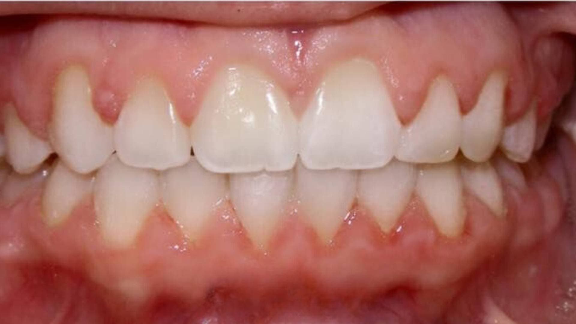 After teeth alignment