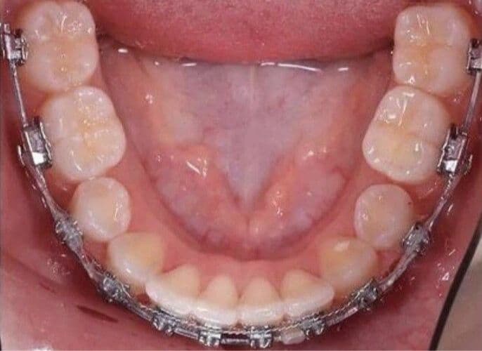 After mandibular orthodontic treatment