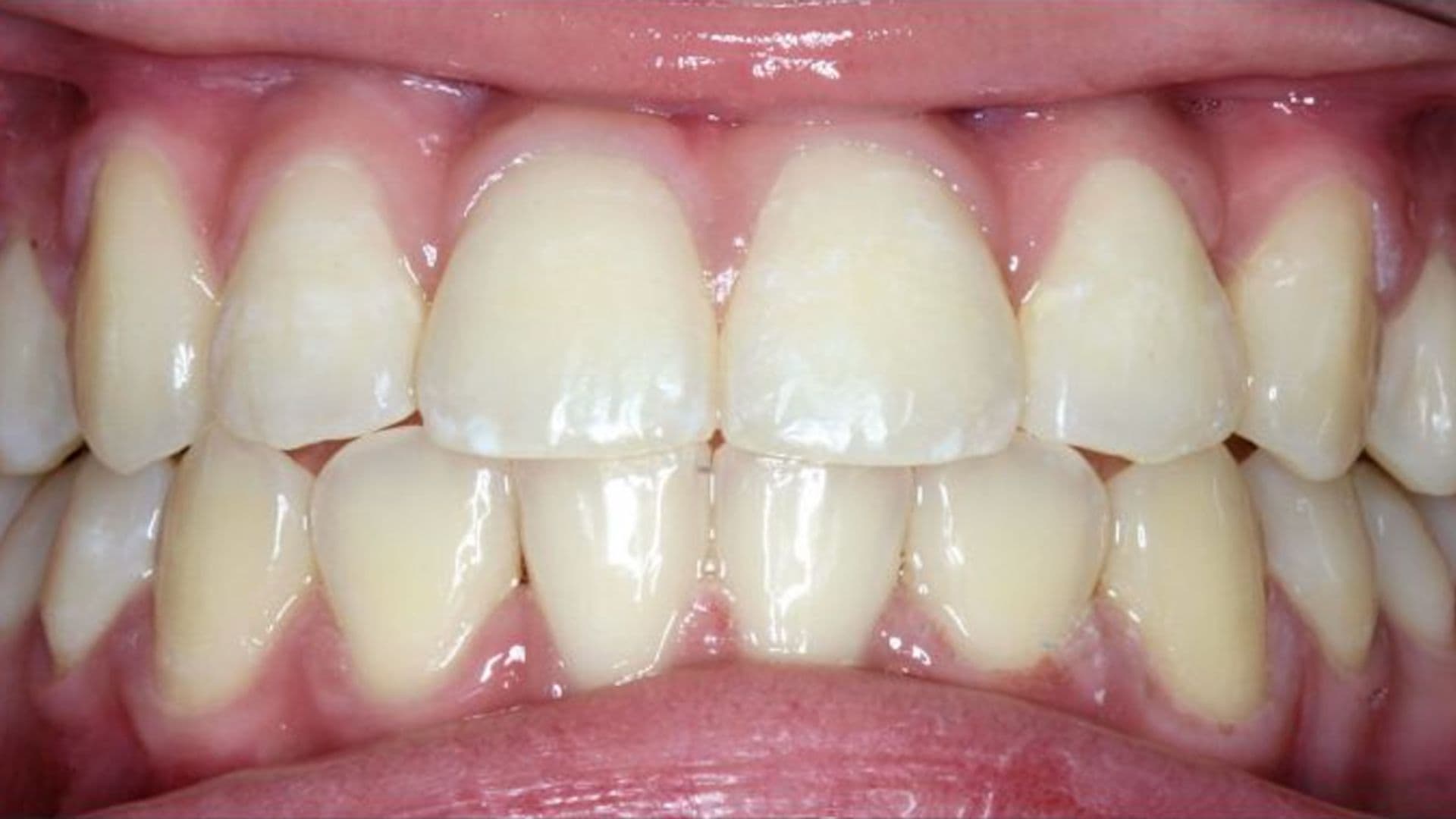 After orthodontic treatment