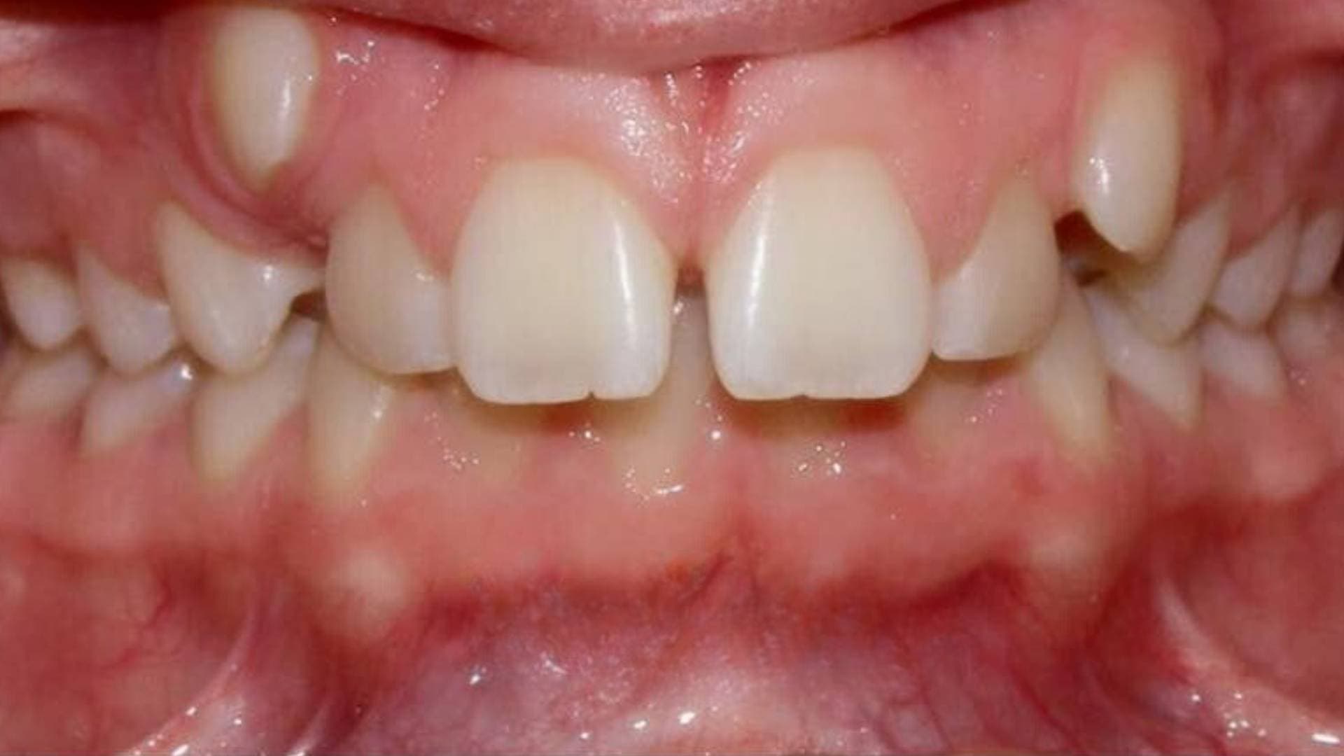 Before teeth alignment