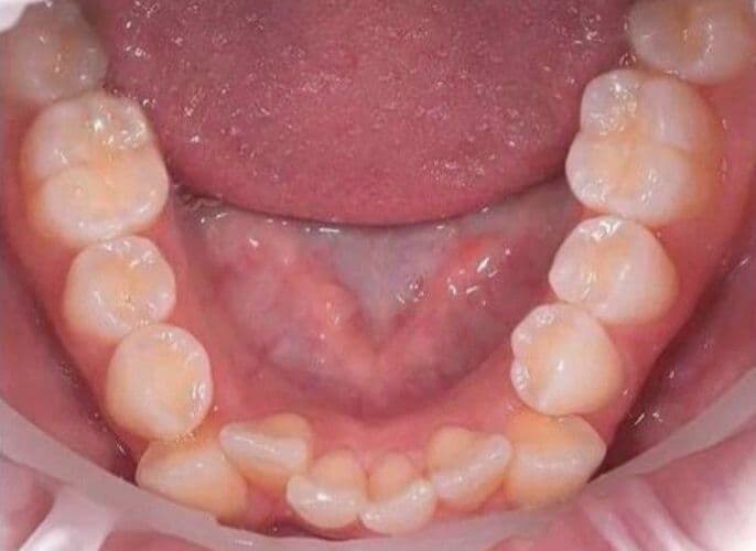 Before mandibular orthodontic treatment