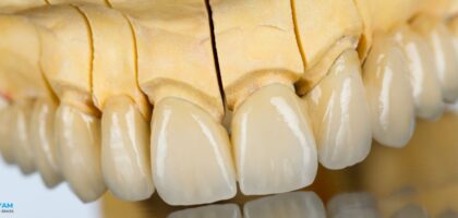 Zirconia teeth , crown in Rajkot gujarat india