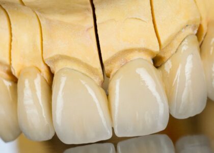 Zirconia teeth , crown in Rajkot gujarat india