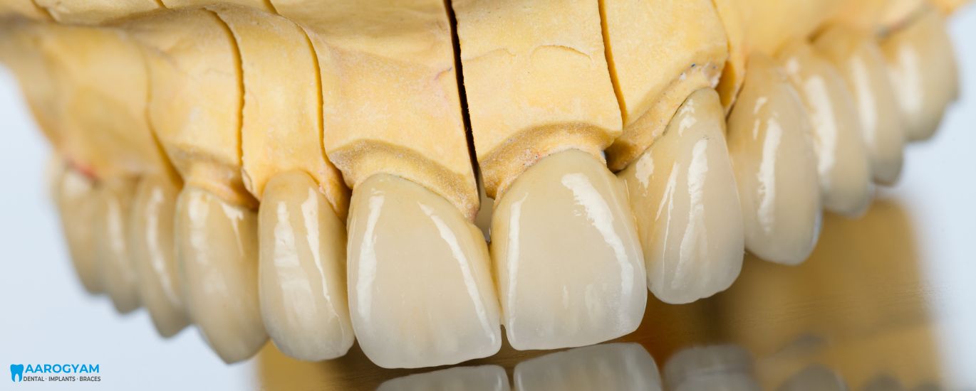 Zirconia teeth , crown in Rajkot gujarat india